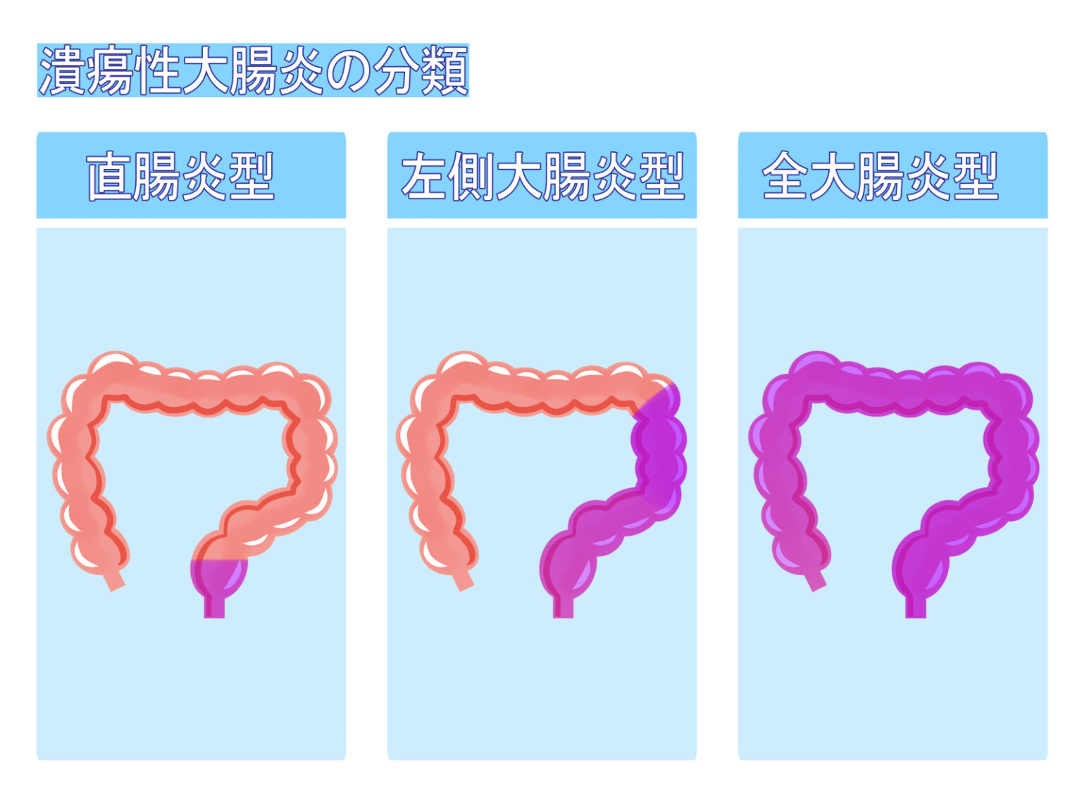 その他のトリガー